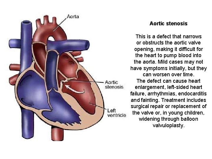 Aortic stenosis This is a defect that narrows or obstructs the aortic valve opening,