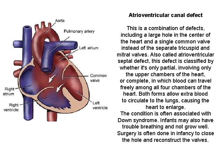 Atrioventricular canal defect This is a combination of defects, including a large hole in