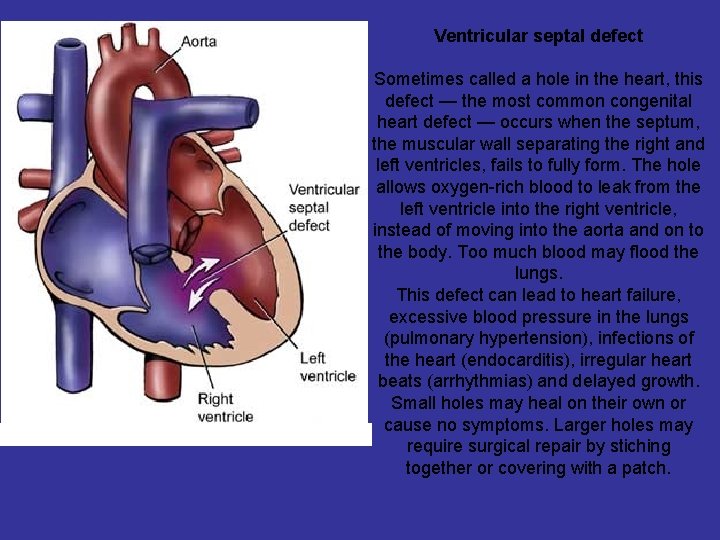 Ventricular septal defect Sometimes called a hole in the heart, this defect — the