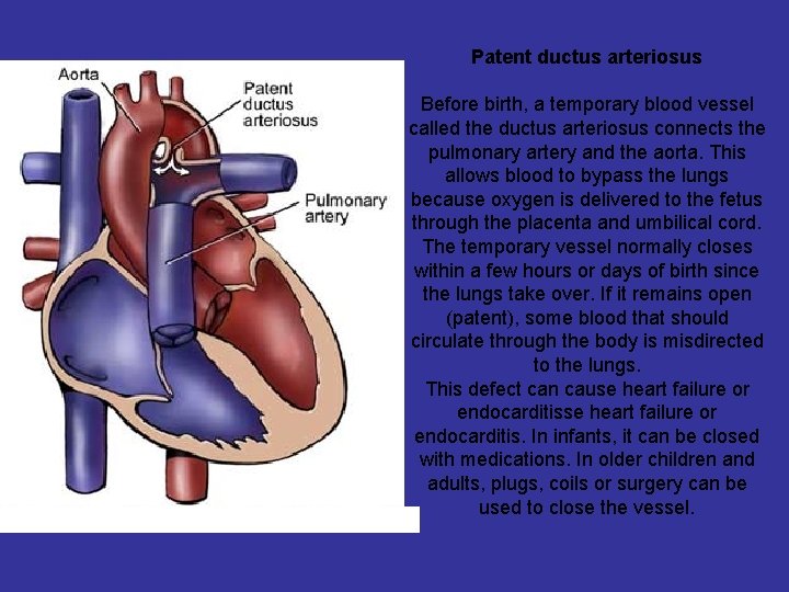 Patent ductus arteriosus Before birth, a temporary blood vessel called the ductus arteriosus connects