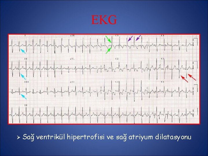 EKG Ø Sağ ventrikül hipertrofisi ve sağ atriyum dilatasyonu EKG Ø Sağ ventrikül hipertrofisi ve sağ atriyum dilatasyonu