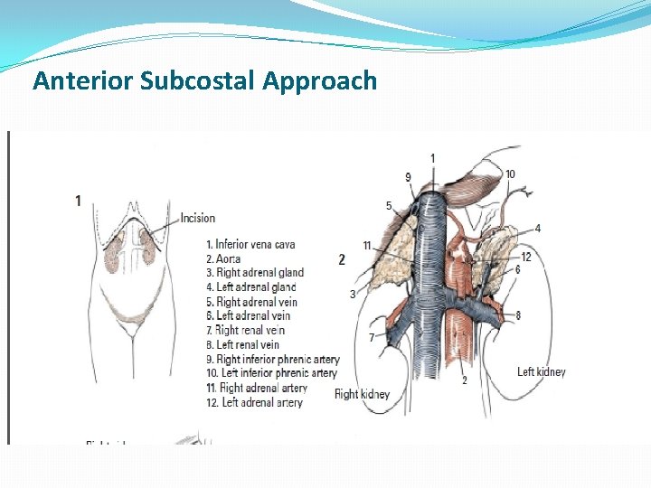 Anterior Subcostal Approach 