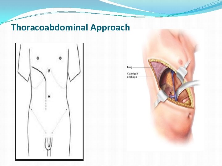 Thoracoabdominal Approach 