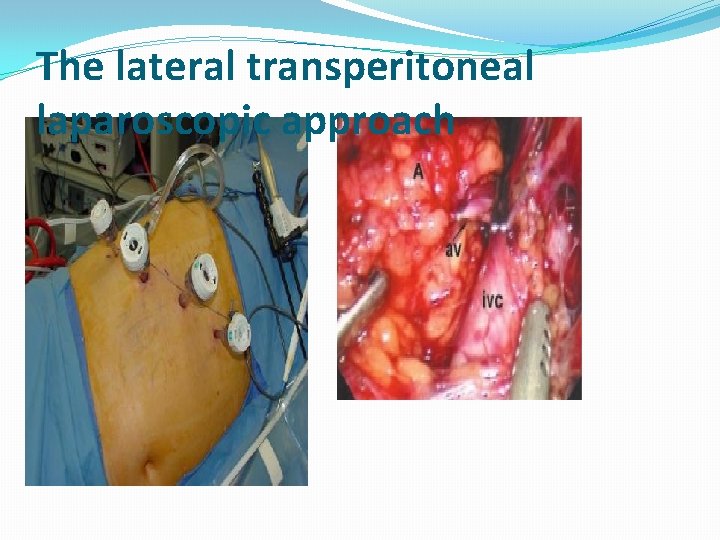 The lateral transperitoneal laparoscopic approach 