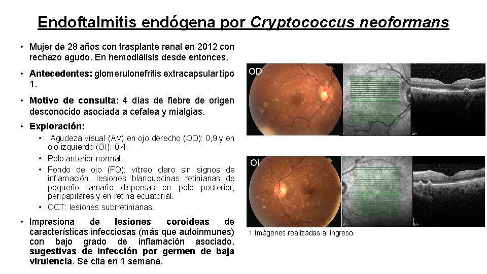 Endoftalmitis endógena por Cryptococcus neoformans • Mujer de 28 años con trasplante renal en