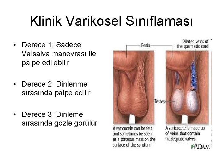 Klinik Varikosel Sınıflaması • Derece 1: Sadece Valsalva manevrası ile palpe edilebilir • Derece