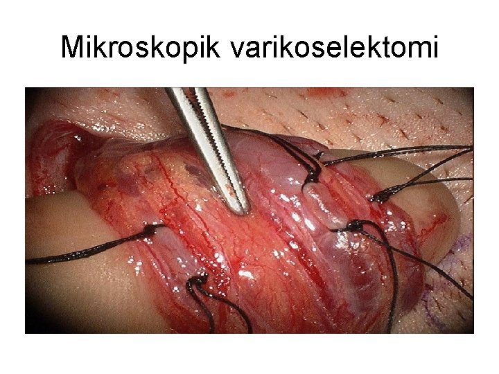 Mikroskopik varikoselektomi 