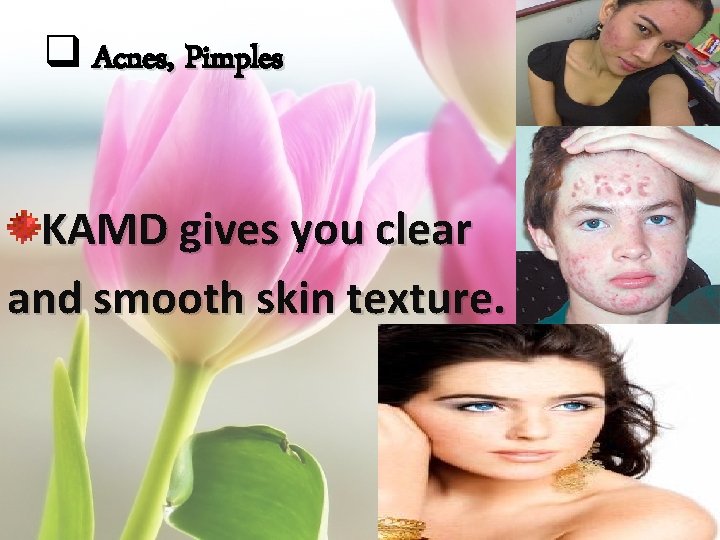 q Acnes, Pimples KAMD gives you clear and smooth skin texture. 