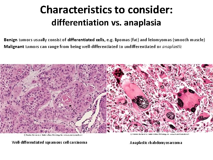 Characteristics to consider: differentiation vs. anaplasia Benign tumors usually consist of differentiated cells, e. Characteristics to consider: differentiation vs. anaplasia Benign tumors usually consist of differentiated cells, e.
