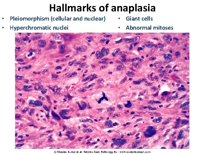Hallmarks of anaplasia • Pleiomorphism (cellular and nuclear) • Hyperchromatic nuclei • Giant cells Hallmarks of anaplasia • Pleiomorphism (cellular and nuclear) • Hyperchromatic nuclei • Giant cells
