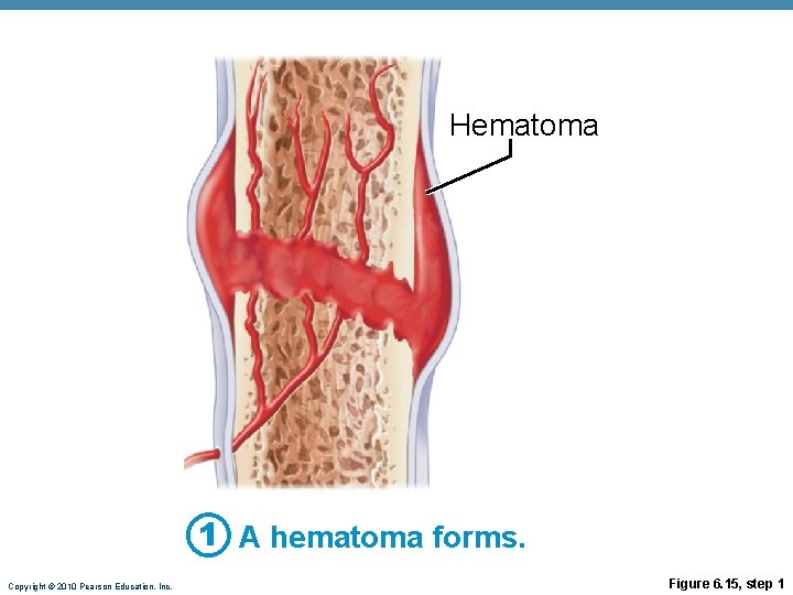 Hematoma 1 A hematoma forms. Copyright © 2010 Pearson Education, Inc. Figure 6. 15, Hematoma 1 A hematoma forms. Copyright © 2010 Pearson Education, Inc. Figure 6. 15,