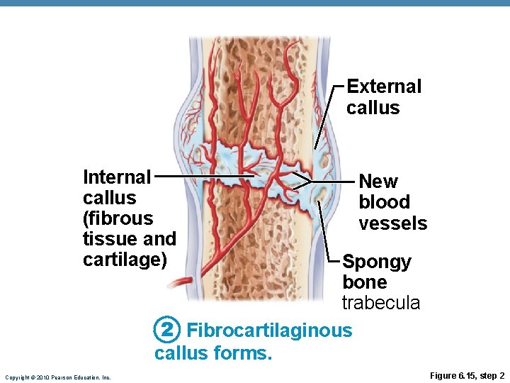 External callus Internal callus (fibrous tissue and cartilage) New blood vessels Spongy bone trabecula External callus Internal callus (fibrous tissue and cartilage) New blood vessels Spongy bone trabecula