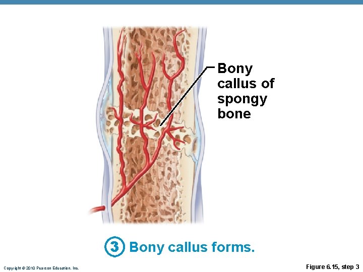 Bony callus of spongy bone 3 Bony callus forms. Copyright © 2010 Pearson Education, Bony callus of spongy bone 3 Bony callus forms. Copyright © 2010 Pearson Education,