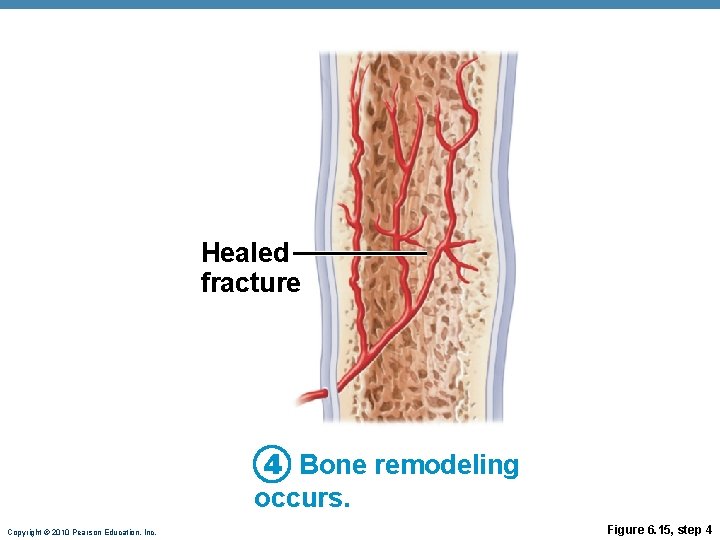 Healed fracture 4 Bone remodeling occurs. Copyright © 2010 Pearson Education, Inc. Figure 6. Healed fracture 4 Bone remodeling occurs. Copyright © 2010 Pearson Education, Inc. Figure 6.