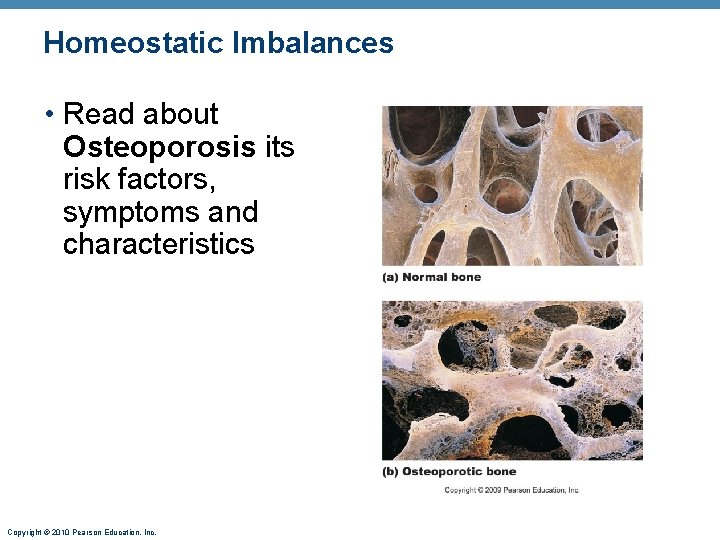 Homeostatic Imbalances • Read about Osteoporosis its risk factors, symptoms and characteristics Copyright © Homeostatic Imbalances • Read about Osteoporosis its risk factors, symptoms and characteristics Copyright ©