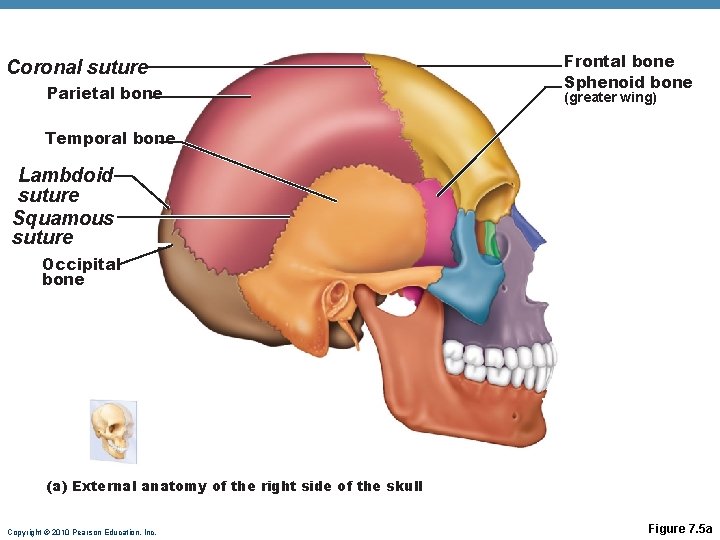 Coronal suture Parietal bone Frontal bone Sphenoid bone (greater wing) Temporal bone Lambdoid suture Coronal suture Parietal bone Frontal bone Sphenoid bone (greater wing) Temporal bone Lambdoid suture