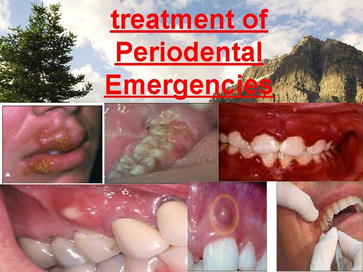 treatment of Periodental Emergencies 