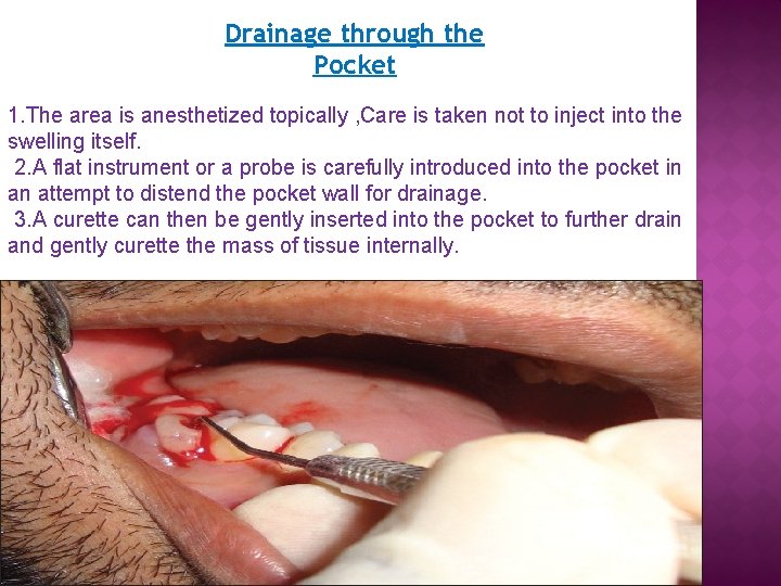 Drainage through the Pocket 1. The area is anesthetized topically , Care is taken Drainage through the Pocket 1. The area is anesthetized topically , Care is taken