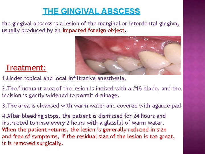 THE GINGIVAL ABSCESS the gingival abscess is a lesion of the marginal or interdental
