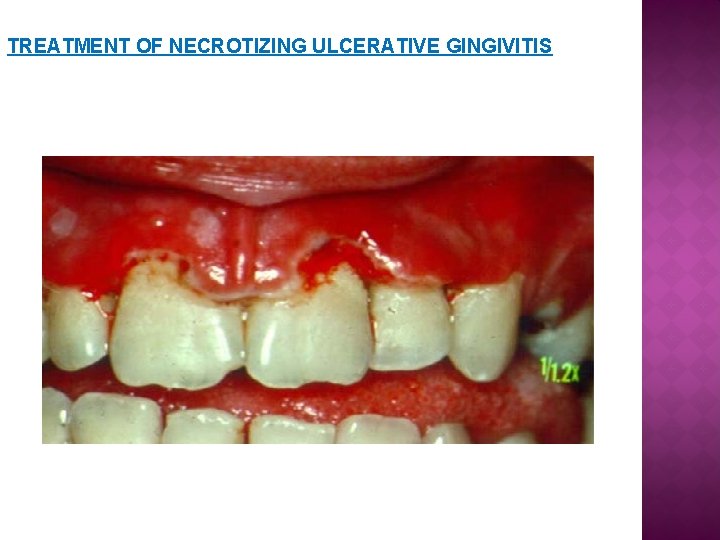 TREATMENT OF NECROTIZING ULCERATIVE GINGIVITIS TREATMENT OF NECROTIZING ULCERATIVE GINGIVITIS