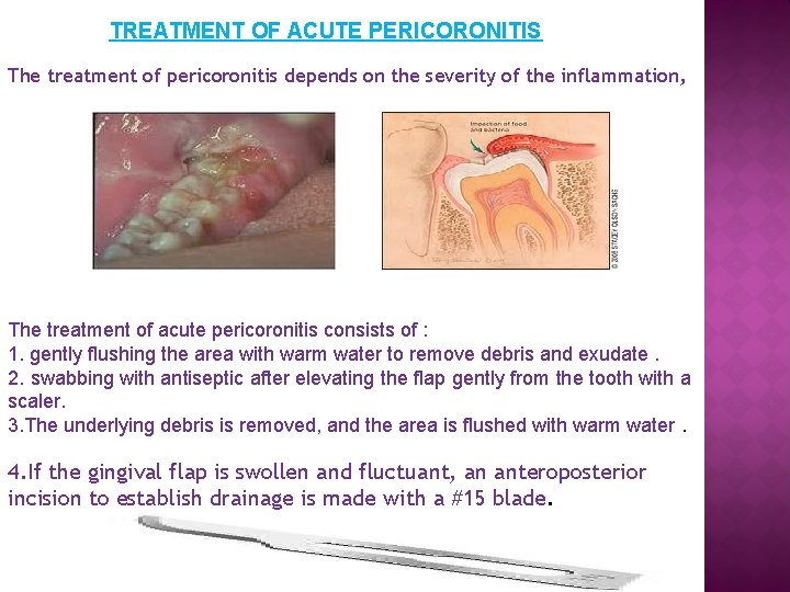 TREATMENT OF ACUTE PERICORONITIS The treatment of pericoronitis depends on the severity of the