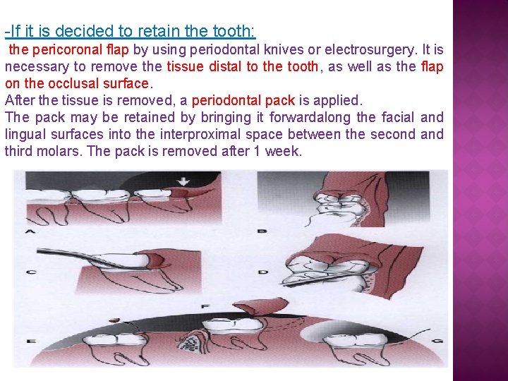 -If it is decided to retain the tooth: the pericoronal flap by using periodontal -If it is decided to retain the tooth: the pericoronal flap by using periodontal