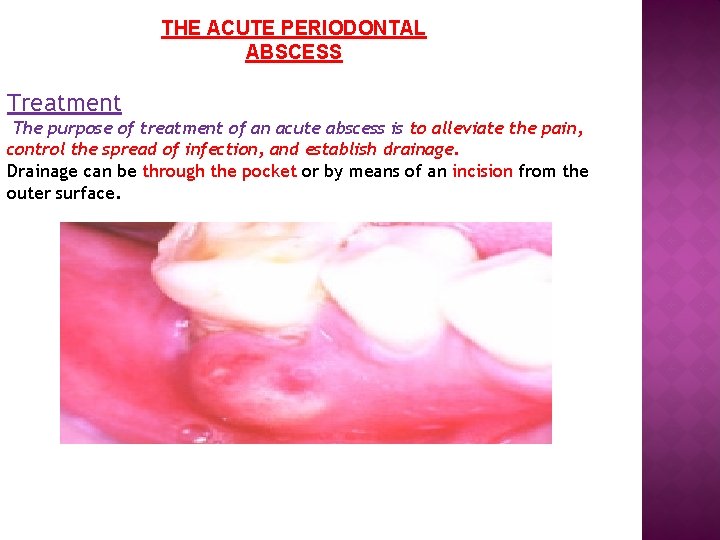 THE ACUTE PERIODONTAL ABSCESS Treatment The purpose of treatment of an acute abscess is