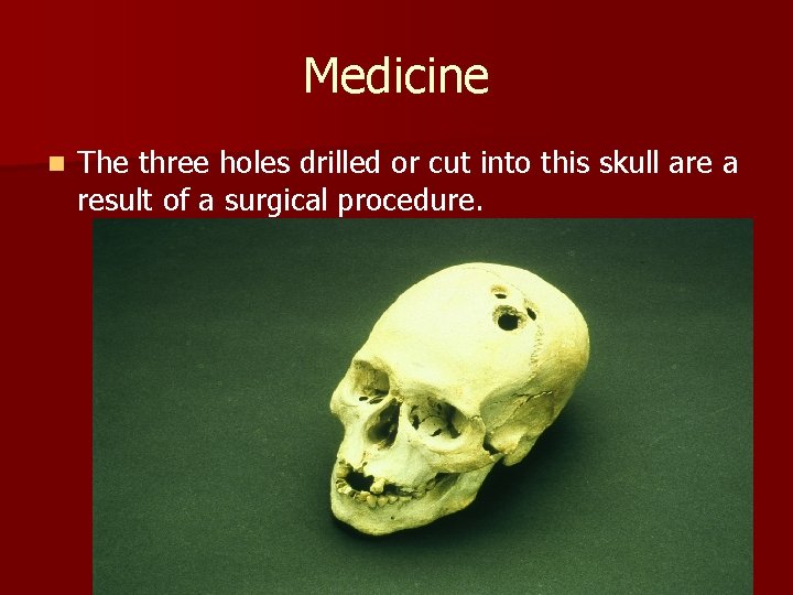 Medicine n The three holes drilled or cut into this skull are a result