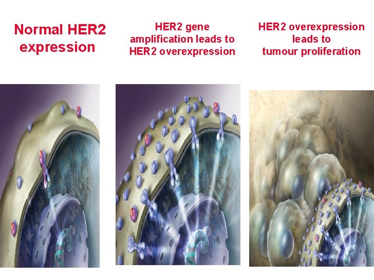 Normal HER 2 expression HER 2 gene amplification leads to HER 2 overexpression leads