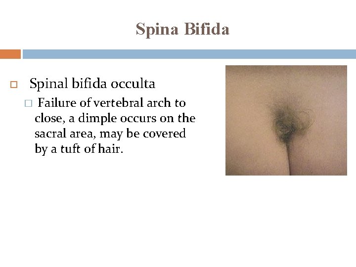 Spina Bifida Spinal bifida occulta � Failure of vertebral arch to close, a dimple