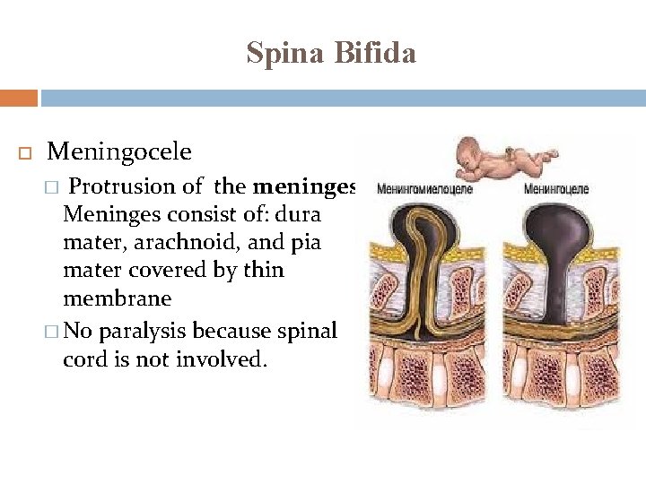 Spina Bifida Meningocele � Protrusion of the meninges. Meninges consist of: dura mater, arachnoid,