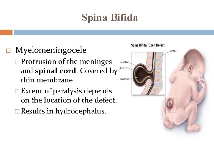 Spina Bifida Myelomeningocele � Protrusion of the meninges and spinal cord. Covered by thin