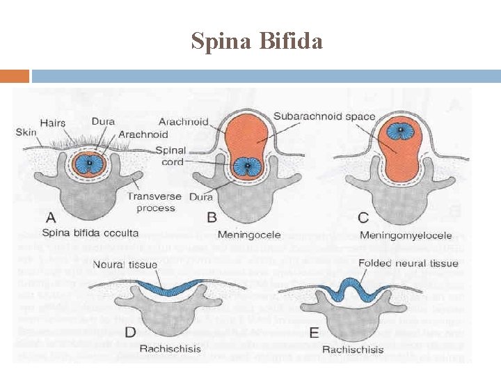 Spina Bifida 