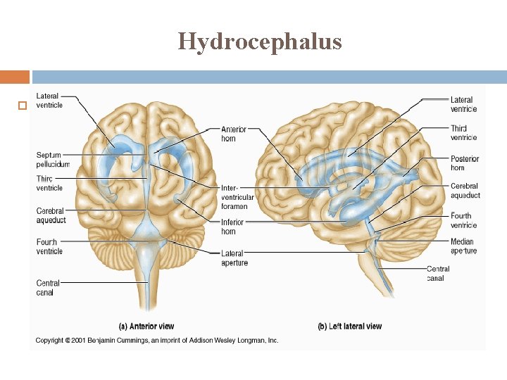 Hydrocephalus 