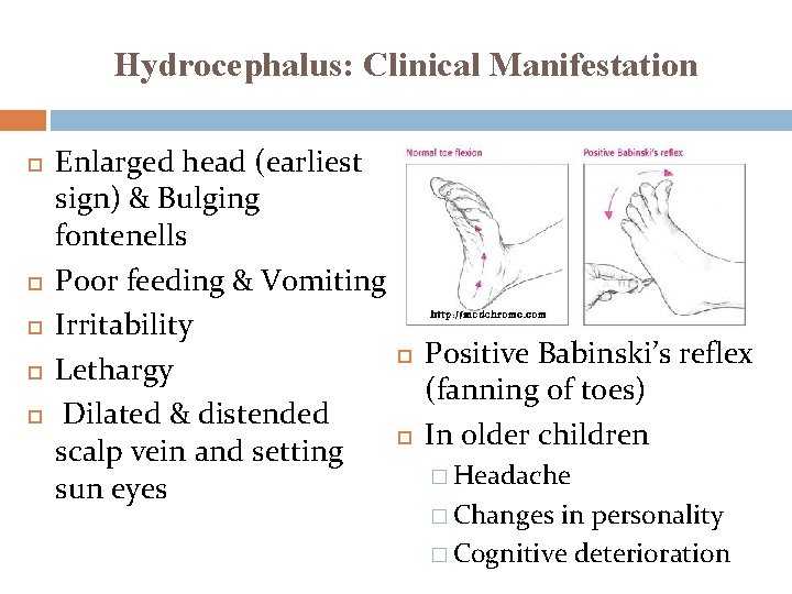 Hydrocephalus: Clinical Manifestation Enlarged head (earliest sign) & Bulging fontenells Poor feeding & Vomiting