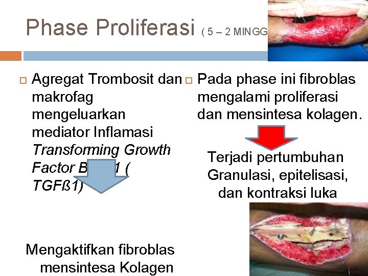 Phase Proliferasi ( 5 – 2 MINGGU ) Agregat Trombosit dan makrofag mengeluarkan mediator