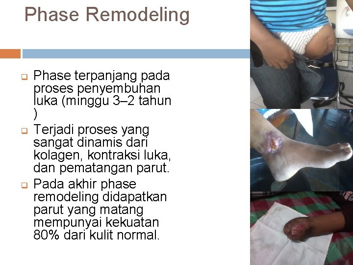 Phase Remodeling q q q Phase terpanjang pada proses penyembuhan luka (minggu 3– 2