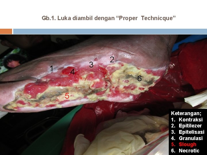 Gb. 1. Luka diambil dengan “Proper Technicque” 1 4 3 2 6 5 Keterangan;