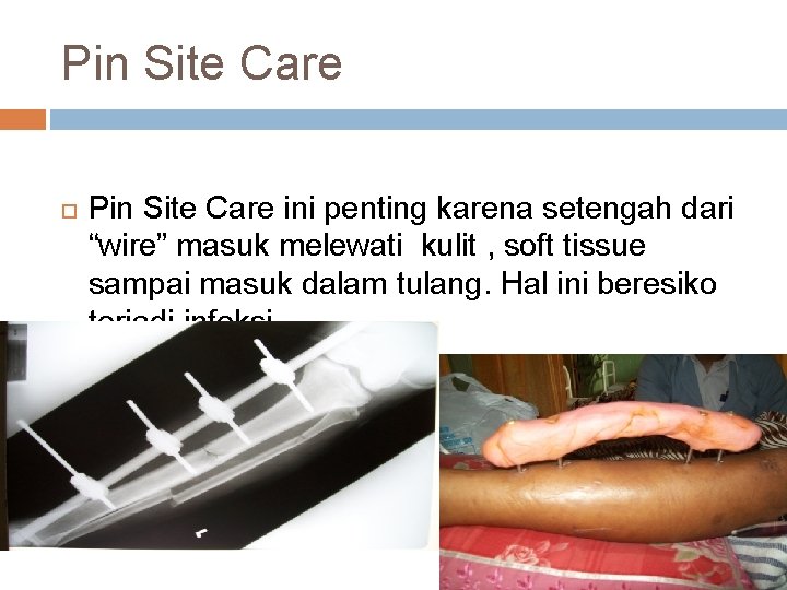 Pin Site Care ini penting karena setengah dari “wire” masuk melewati kulit , soft