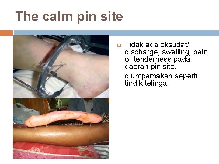 The calm pin site Tidak ada eksudat/ discharge, swelling, pain or tenderness pada daerah