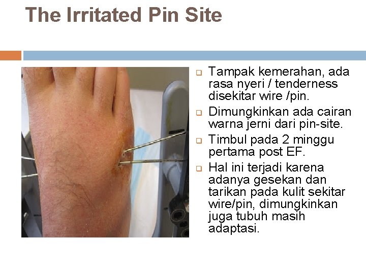 The Irritated Pin Site q q Tampak kemerahan, ada rasa nyeri / tenderness disekitar