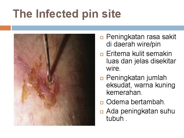 The Infected pin site Peningkatan rasa sakit di daerah wire/pin Eritema kulit semakin luas