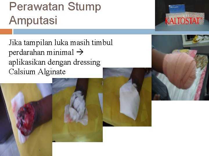 Perawatan Stump Amputasi Jika tampilan luka masih timbul perdarahan minimal aplikasikan dengan dressing Calsium