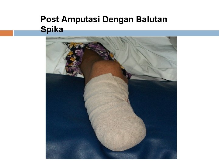 Post Amputasi Dengan Balutan Spika 