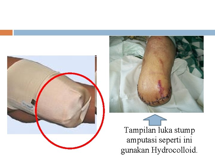 Tampilan luka stump amputasi seperti ini gunakan Hydrocolloid. 