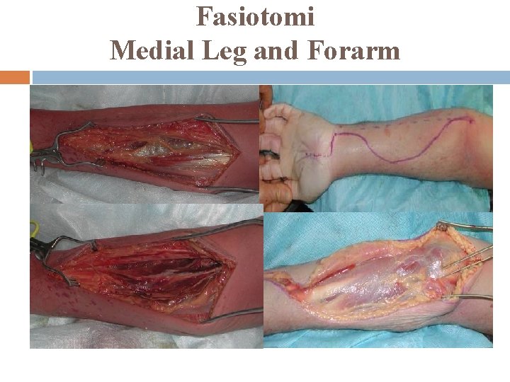 Fasiotomi Medial Leg and Forarm 