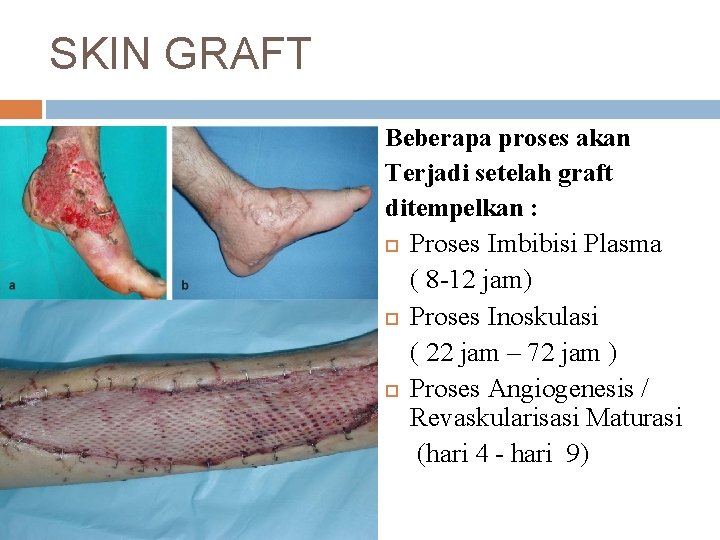 SKIN GRAFT Beberapa proses akan Terjadi setelah graft ditempelkan : : Proses Imbibisi Plasma