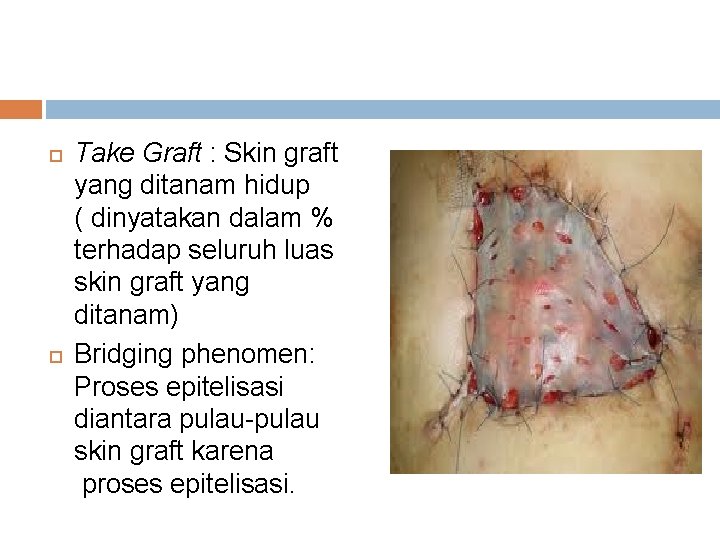  Take Graft : Skin graft yang ditanam hidup ( dinyatakan dalam % terhadap