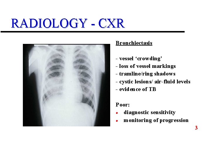 RADIOLOGY - CXR Bronchiectasis - vessel ‘crowding’ - loss of vessel markings - tramline/ring