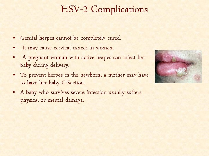 HSV-2 Complications • Genital herpes cannot be completely cured. • It may cause cervical